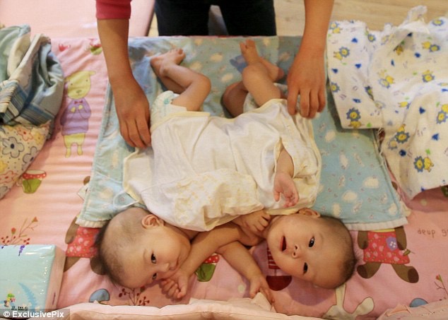 1. Conjoined twins Zheng Hanjing and Zheng Hanwei were abandoned at an orphanage in Pingdingshan City, Henan - article-2520391-19F3C29800000578-708_634x453
